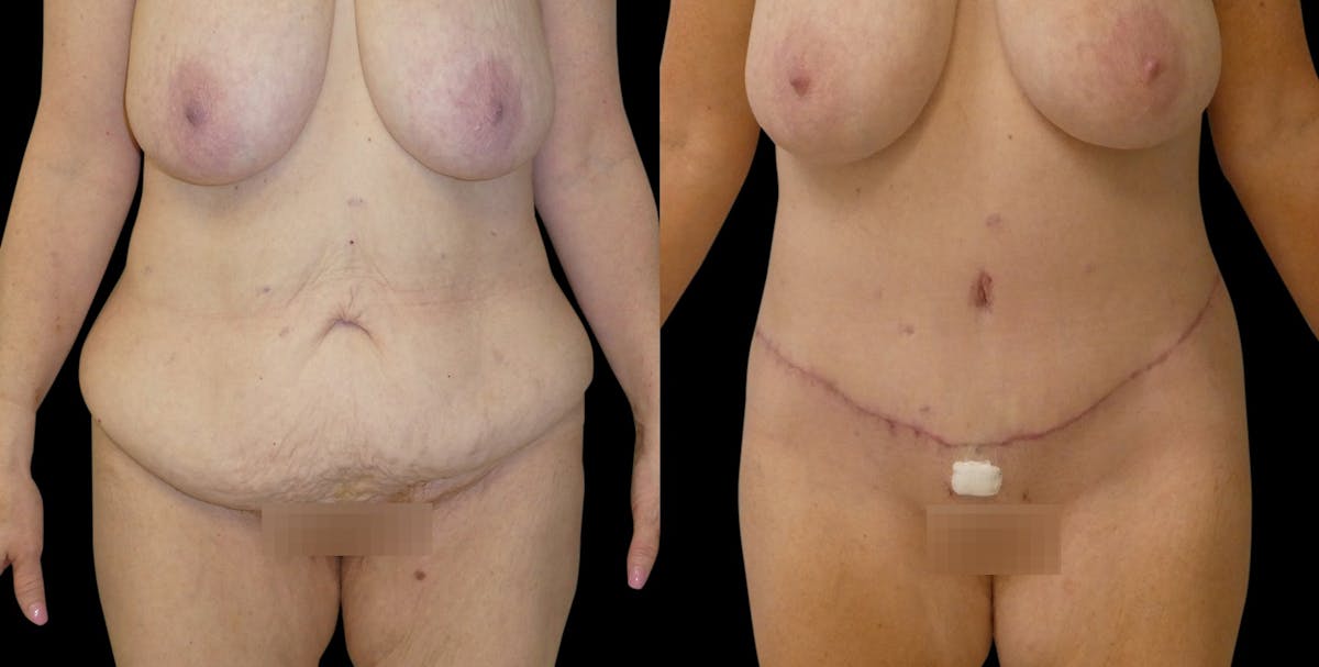 Tummy Tuck / Reverse Abdominoplasty Before & After Gallery - Patient 330616 - Image 1