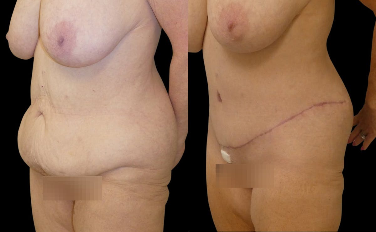 Tummy Tuck / Reverse Abdominoplasty Before & After Gallery - Patient 330616 - Image 3