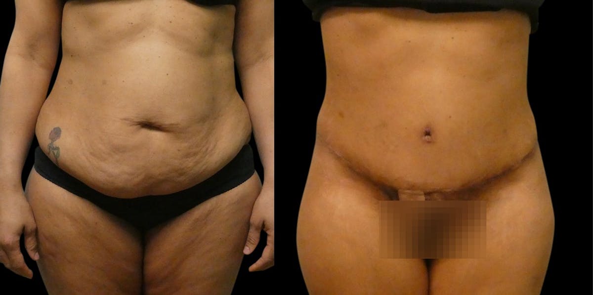Tummy Tuck / Reverse Abdominoplasty Before & After Gallery - Patient 241927 - Image 1