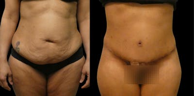 Tummy Tuck / Reverse Abdominoplasty Before & After Gallery - Patient 241927 - Image 1