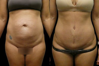 Tummy Tuck / Reverse Abdominoplasty Before & After Gallery - Patient 124526 - Image 1