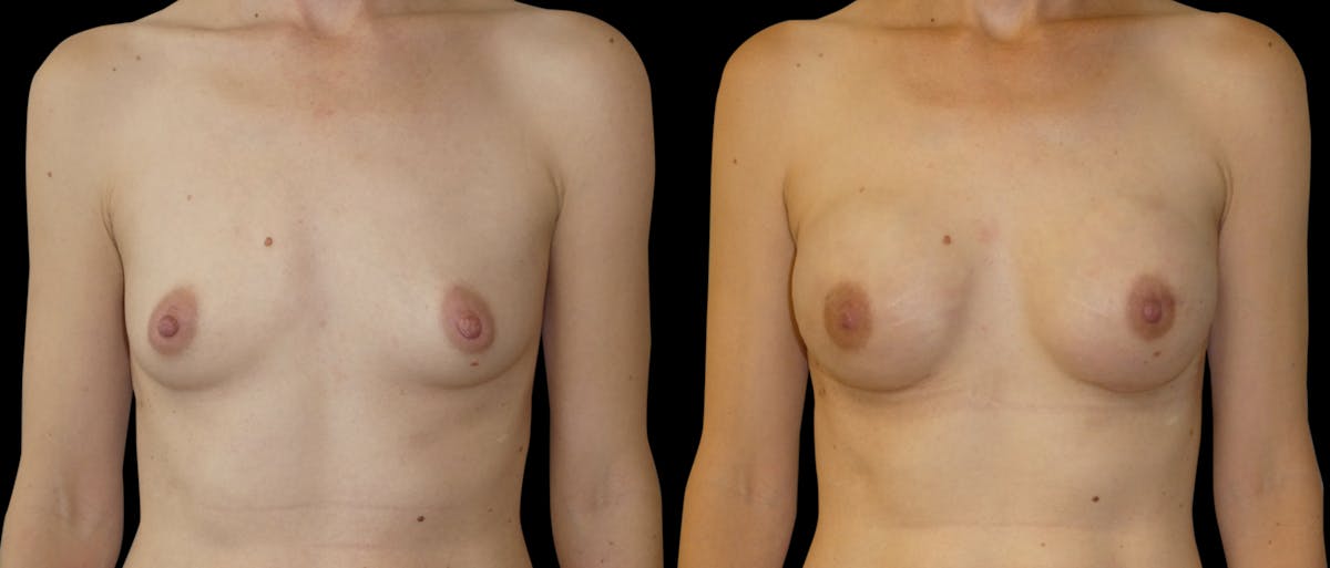 Breast Augmentation Before & After Gallery - Patient 299389 - Image 1