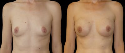 Breast Augmentation Before & After Gallery - Patient 299389 - Image 1