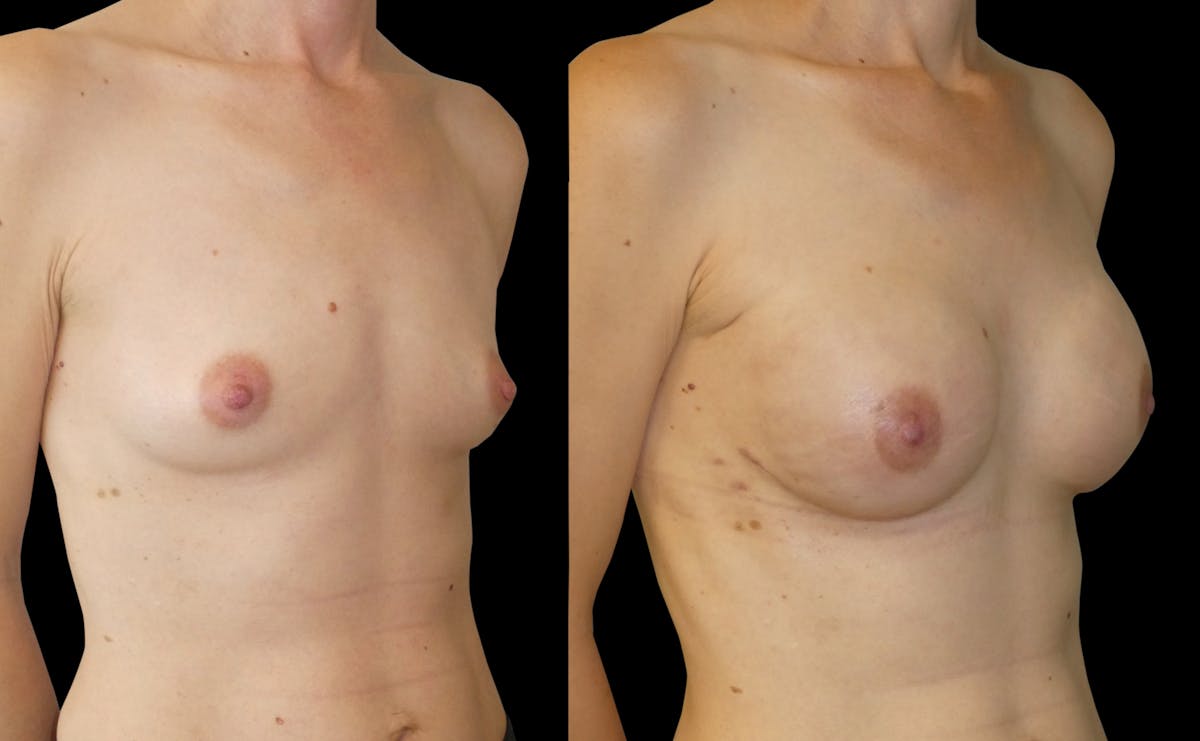 Breast Augmentation Before & After Gallery - Patient 299389 - Image 4
