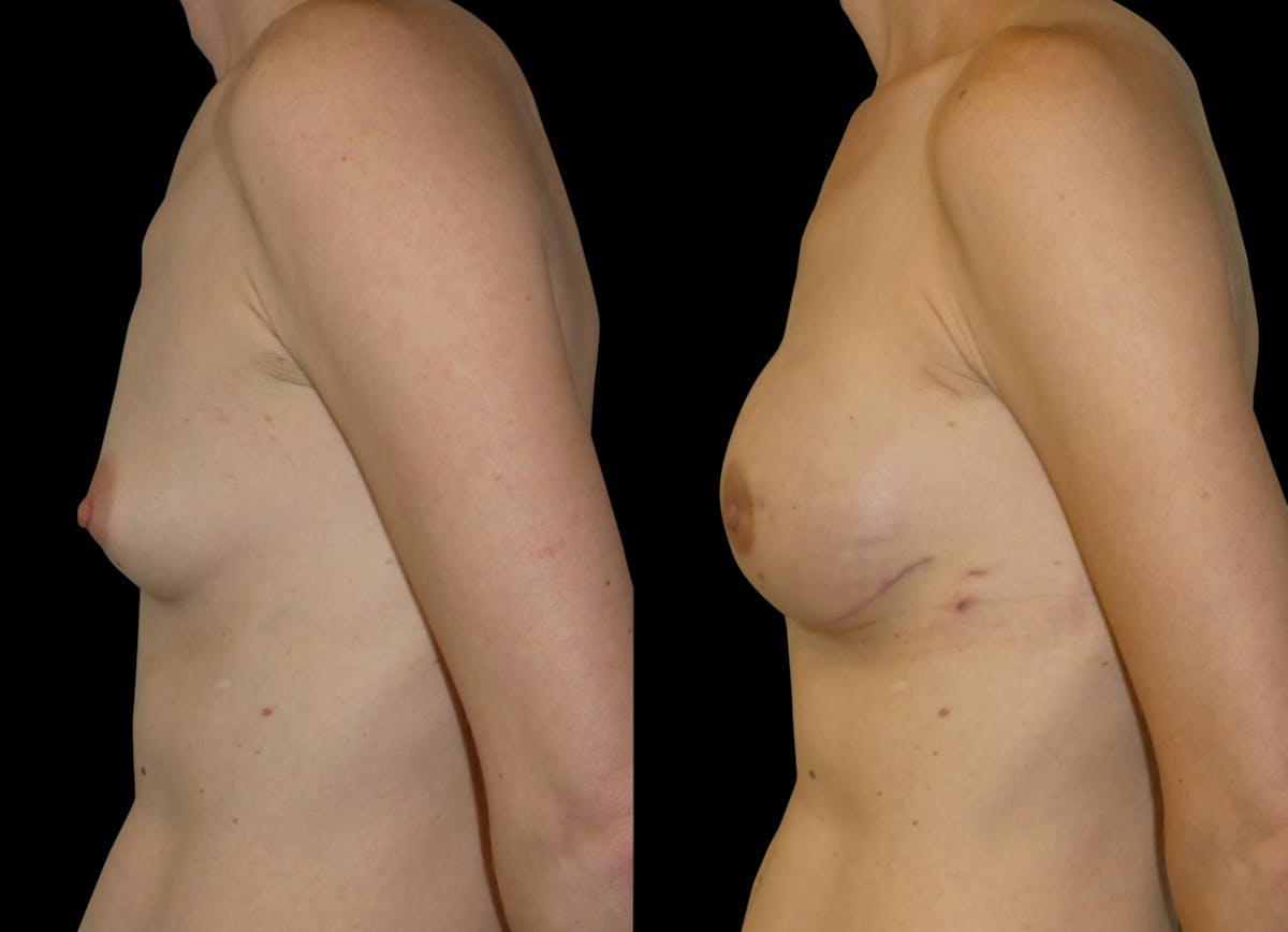 Breast Augmentation Before & After Gallery - Patient 299389 - Image 3