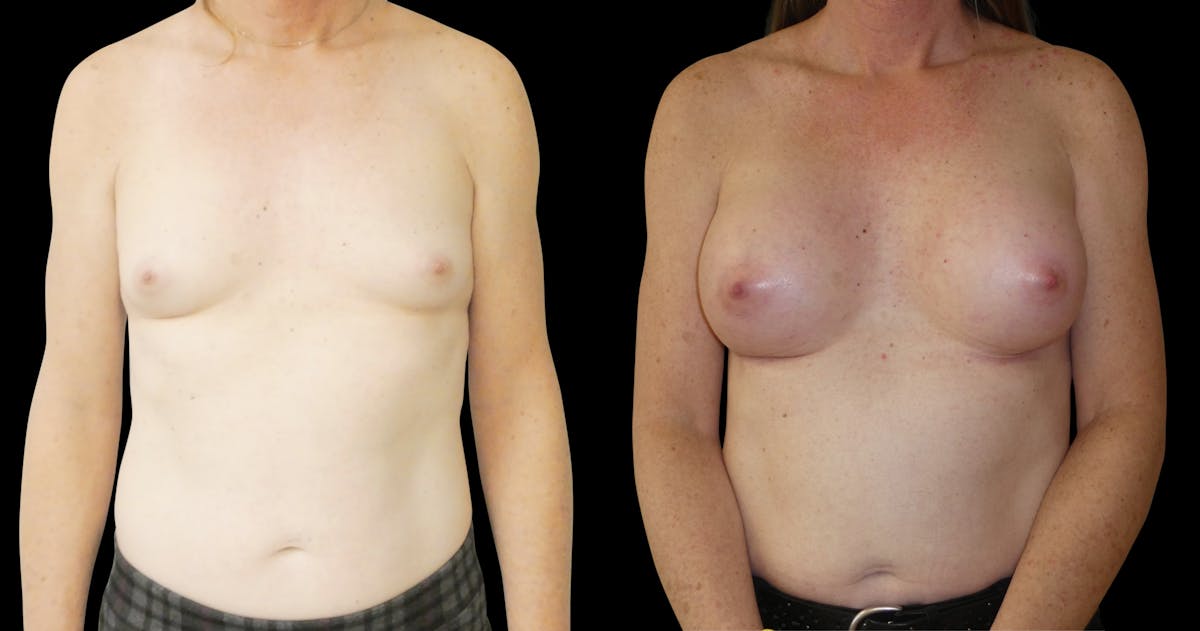 Breast Augmentation Before & After Gallery - Patient 427747 - Image 1