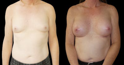 Breast Augmentation Before & After Gallery - Patient 427747 - Image 1