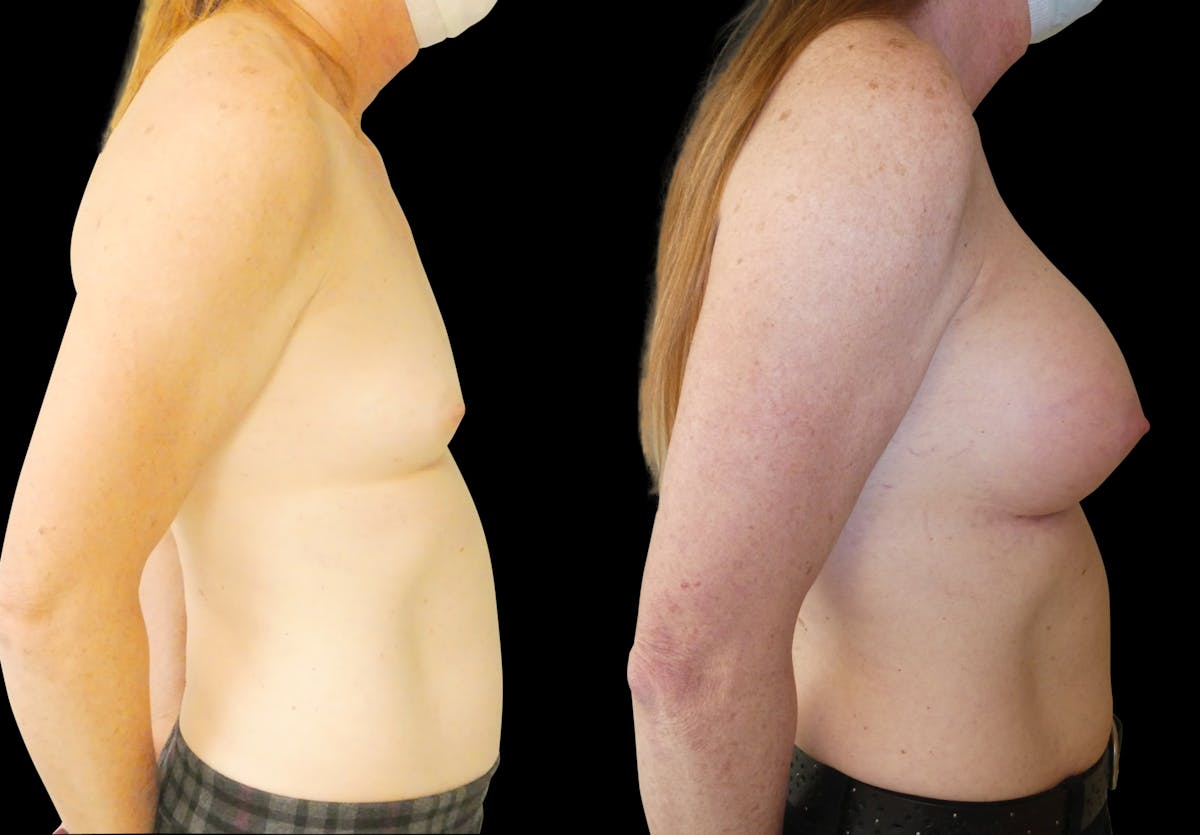 Breast Augmentation Before & After Gallery - Patient 427747 - Image 5