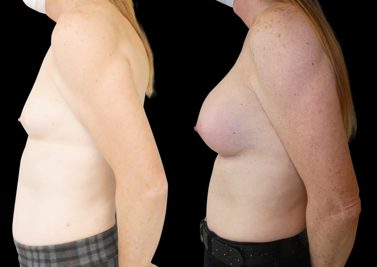 Breast Augmentation Before & After Gallery - Patient 427747 - Image 3