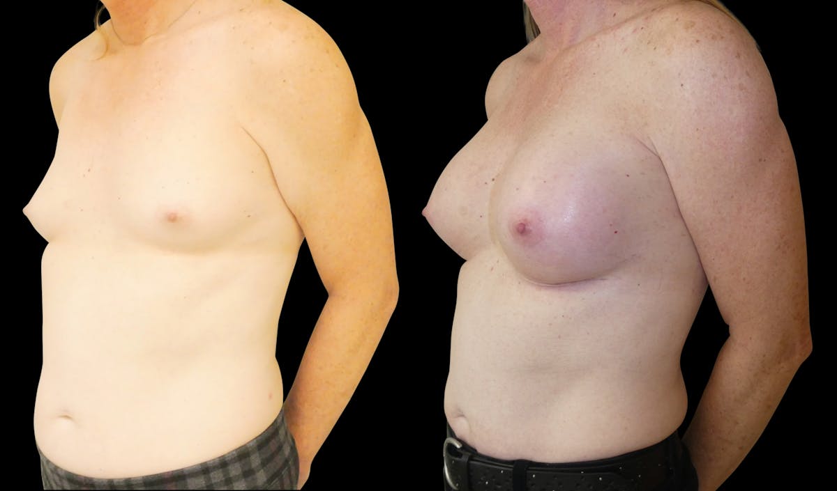 Breast Augmentation Before & After Gallery - Patient 427747 - Image 2