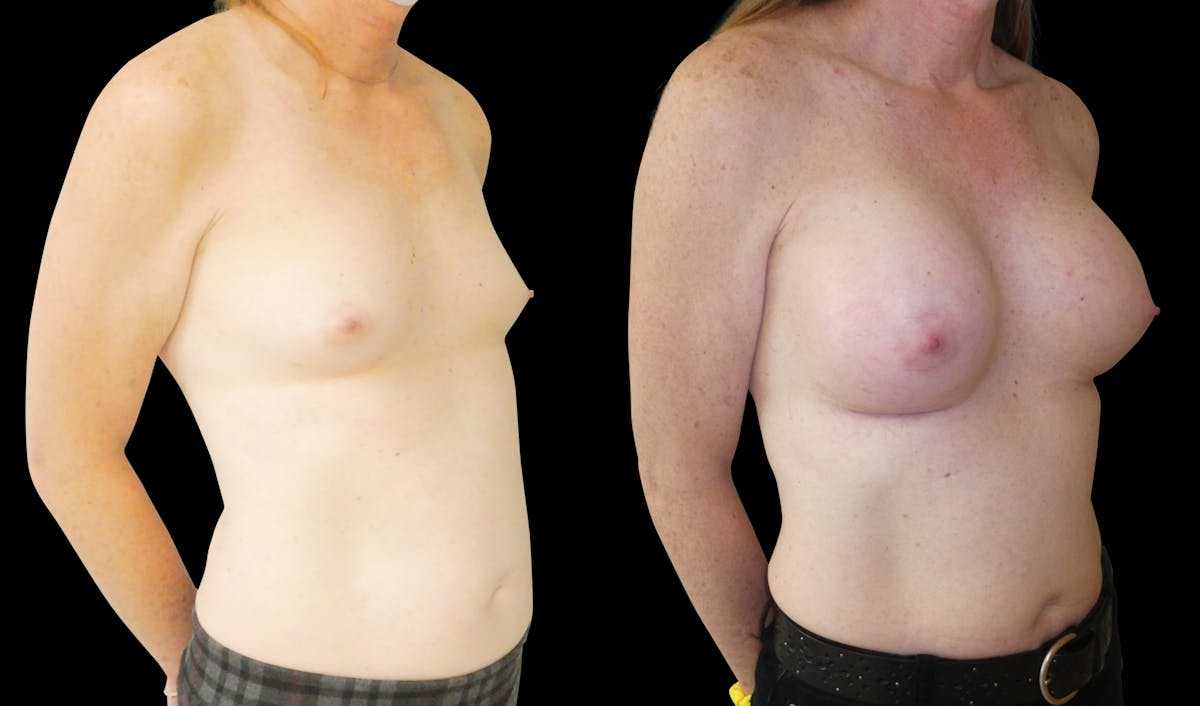 Breast Augmentation Before & After Gallery - Patient 427747 - Image 4