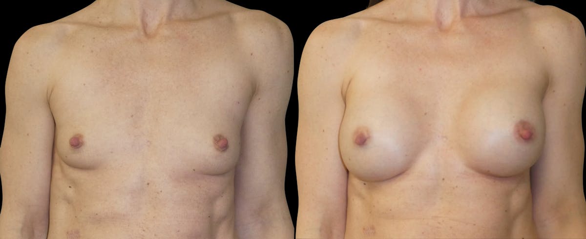 Breast Augmentation Before & After Gallery - Patient 495830 - Image 1