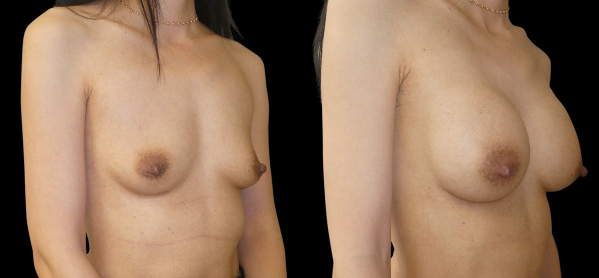 Breast Augmentation Before & After Gallery - Patient 132369 - Image 2