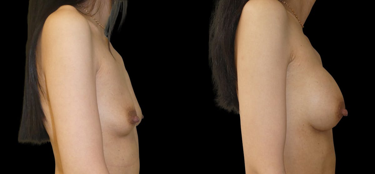 Breast Augmentation Before & After Gallery - Patient 132369 - Image 3