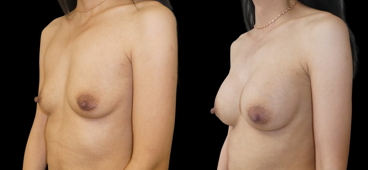 Breast Augmentation Before & After Gallery - Patient 132369 - Image 4