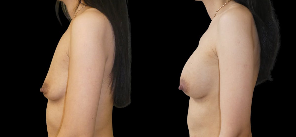Breast Augmentation Before & After Gallery - Patient 132369 - Image 5