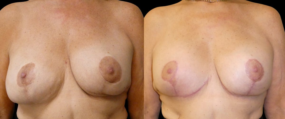 Breast Revision / Implant Exchange Before & After Gallery - Patient 154023 - Image 1