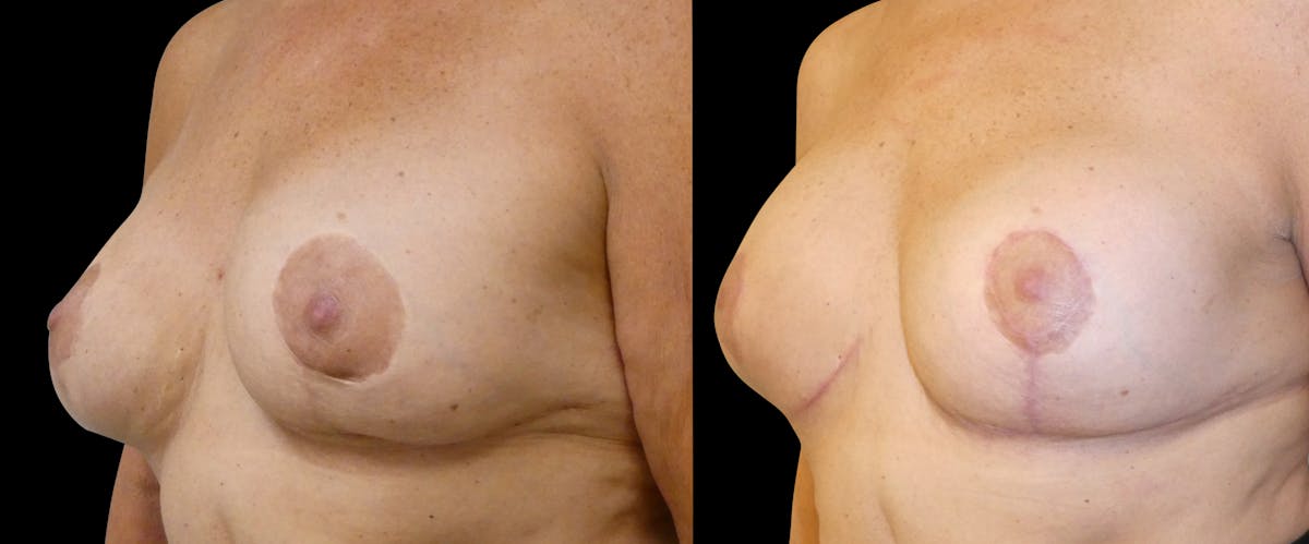 Breast Revision / Implant Exchange Before & After Gallery - Patient 154023 - Image 3