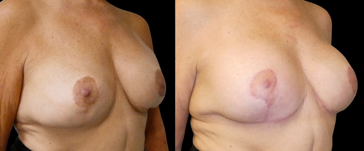 Breast Revision / Implant Exchange Before & After Gallery - Patient 154023 - Image 2