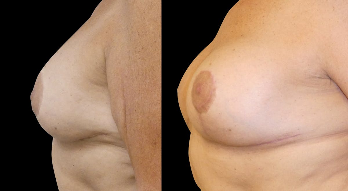 Breast Revision / Implant Exchange Before & After Gallery - Patient 154023 - Image 5
