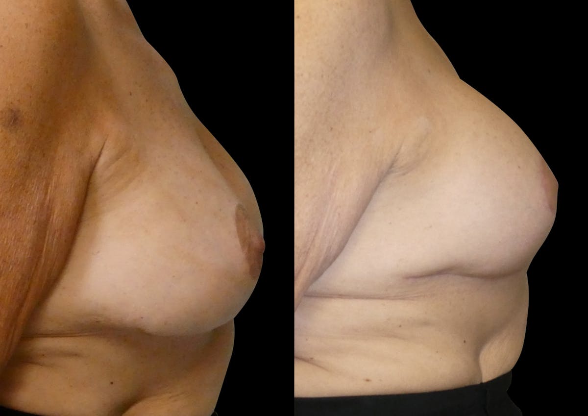 Breast Revision / Implant Exchange Before & After Gallery - Patient 154023 - Image 4
