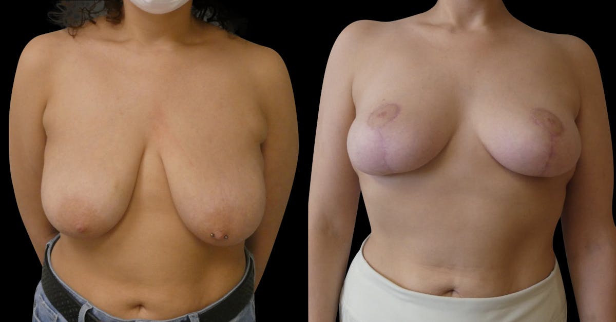 Breast Lift Before & After Gallery - Patient 108647 - Image 1