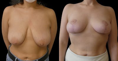 Breast Reduction + Lift Before & After Gallery - Patient 261178 - Image 1