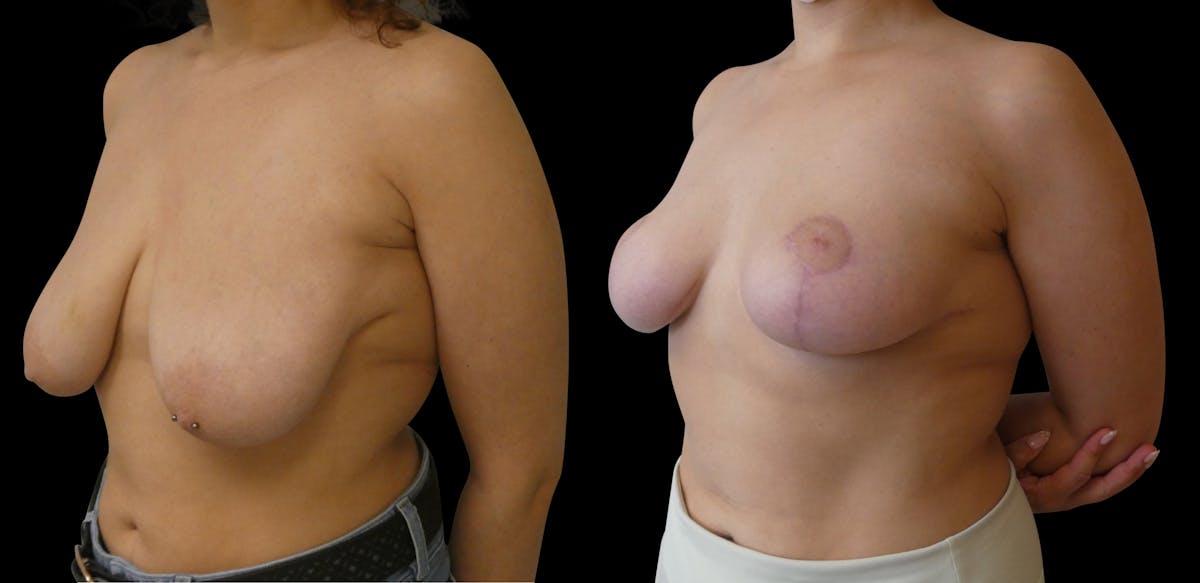 Breast Lift Before & After Gallery - Patient 108647 - Image 2