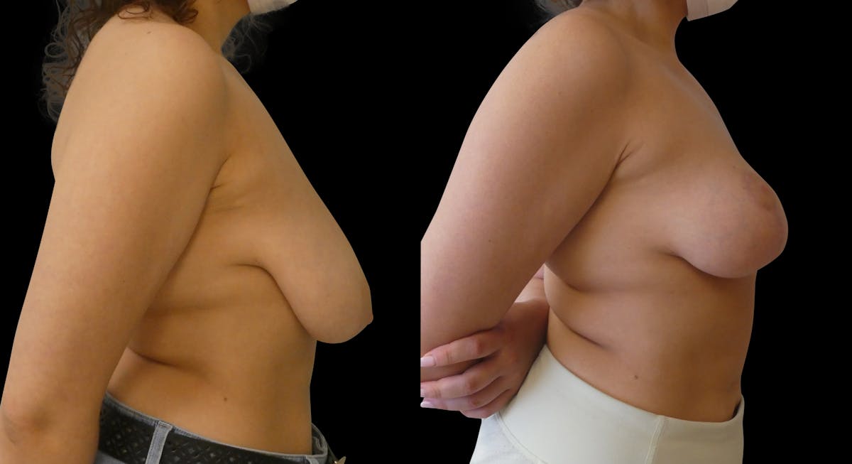 Breast Lift Before & After Gallery - Patient 108647 - Image 4