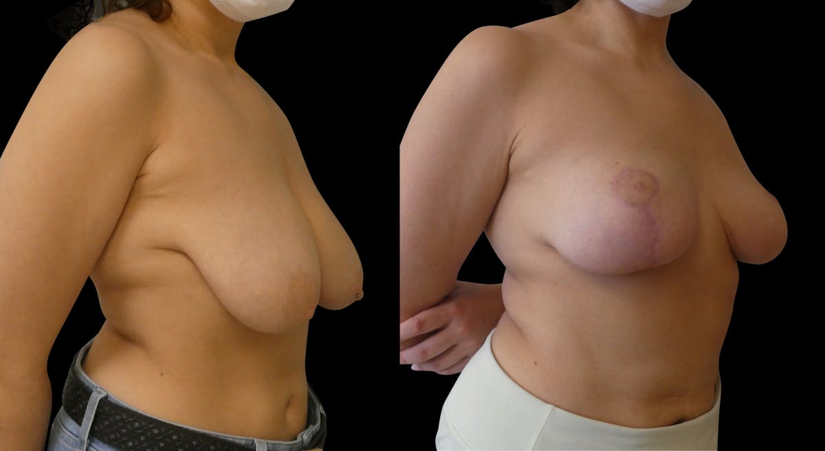 Breast Lift Before & After Gallery - Patient 108647 - Image 5