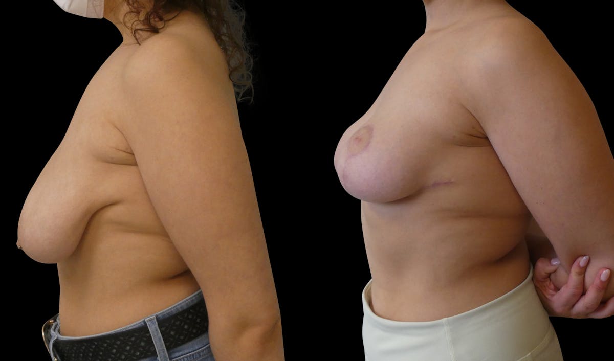 Breast Lift Before & After Gallery - Patient 108647 - Image 3