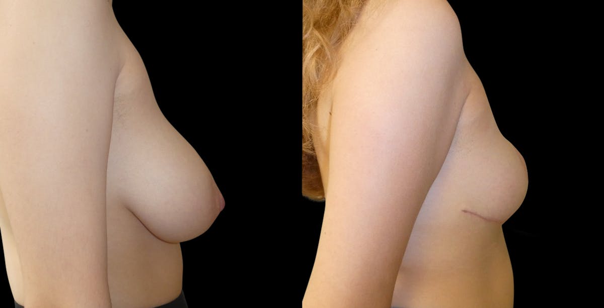 Breast Lift Before & After Gallery - Patient 131140 - Image 3
