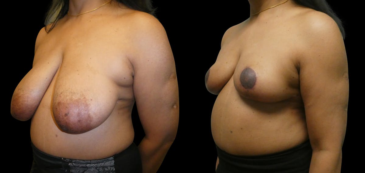 Breast Lift Before & After Gallery - Patient 393946 - Image 2