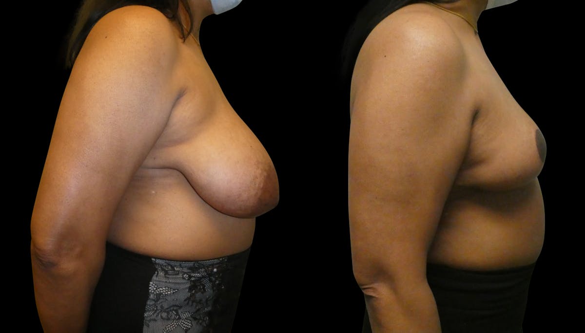 Breast Lift Before & After Gallery - Patient 393946 - Image 4