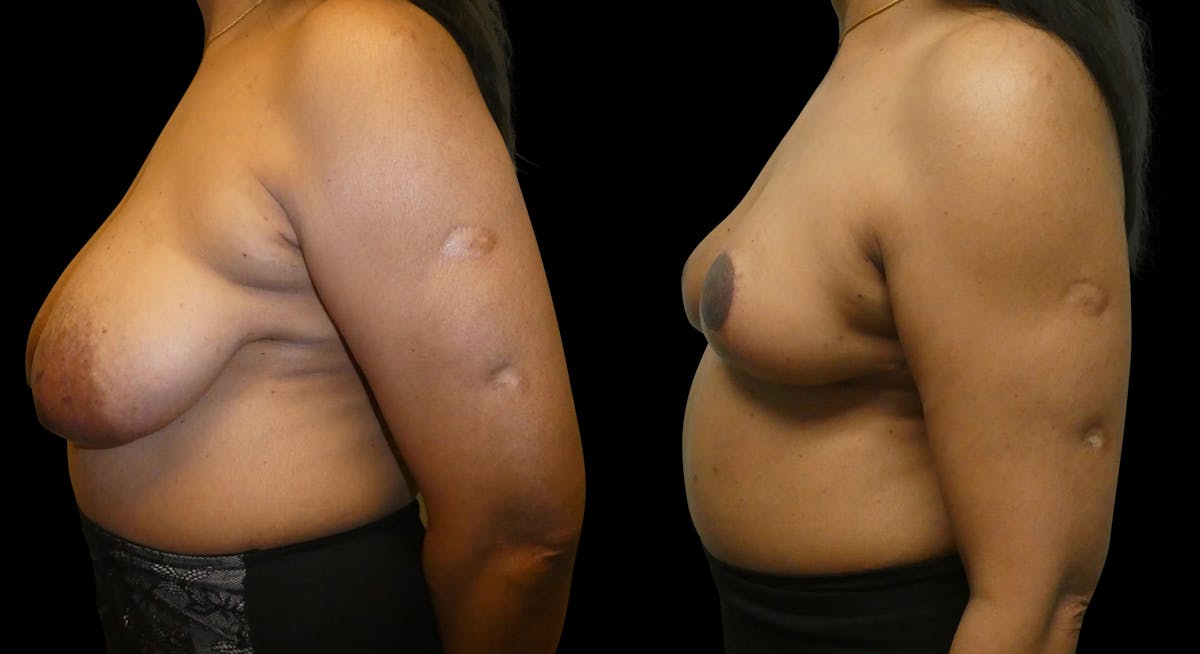 Breast Lift Before & After Gallery - Patient 393946 - Image 3