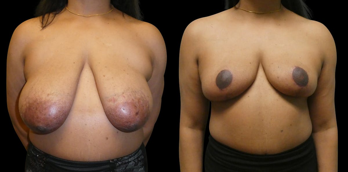 Breast Lift Before & After Gallery - Patient 393946 - Image 1