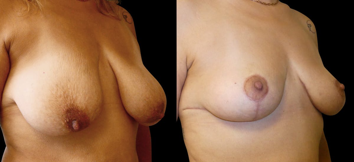 Breast Lift Before & After Gallery - Patient 156609 - Image 5