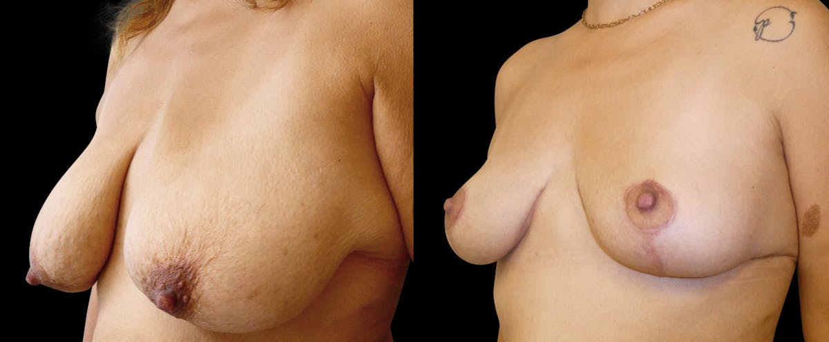 Breast Lift Before & After Gallery - Patient 156609 - Image 2