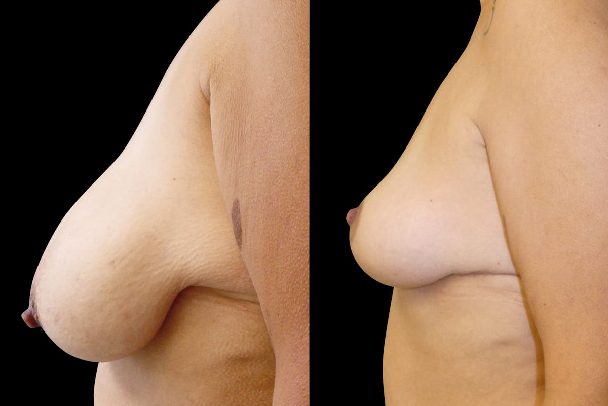 Breast Lift Before & After Gallery - Patient 156609 - Image 4