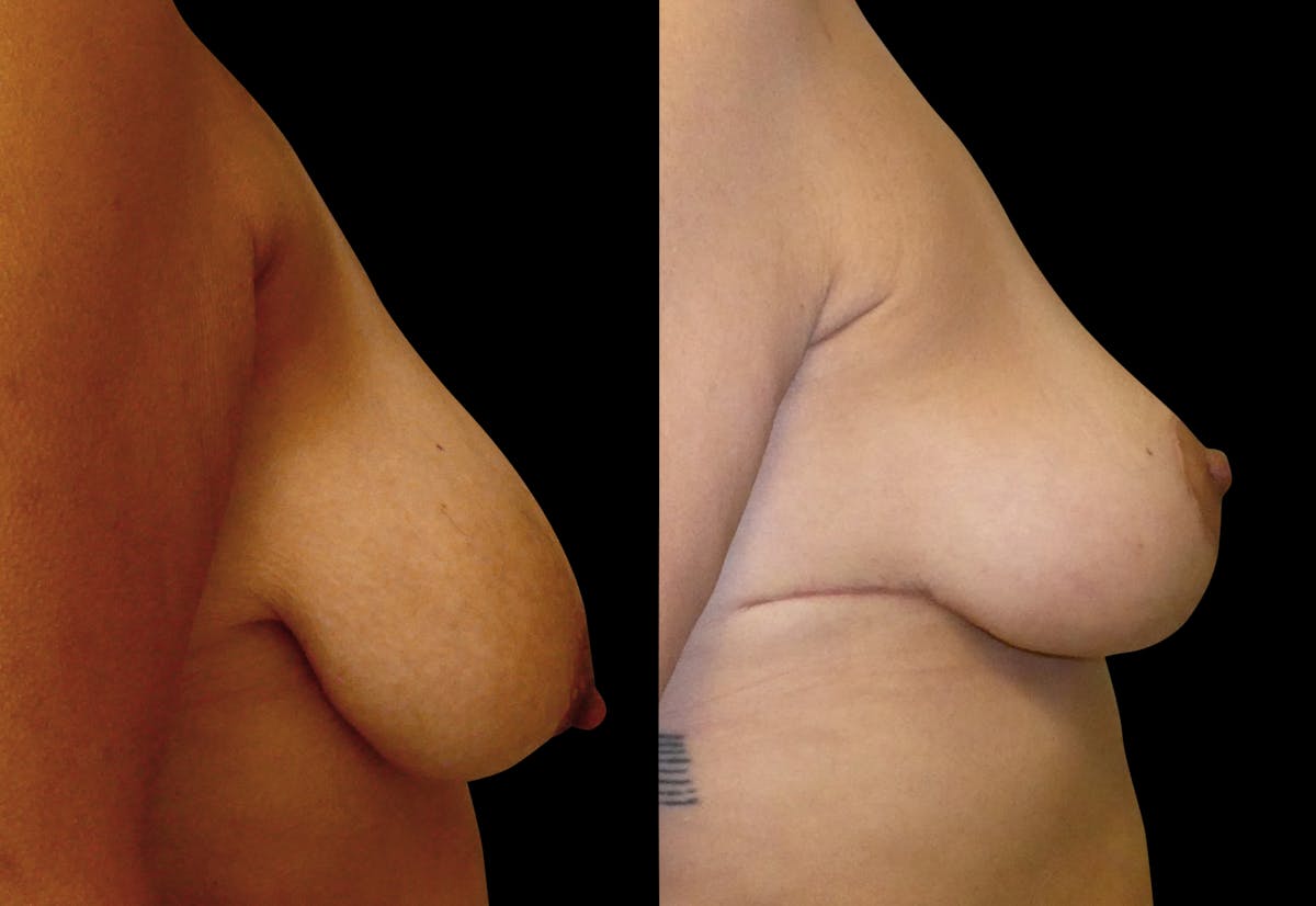 Breast Lift Before & After Gallery - Patient 156609 - Image 3