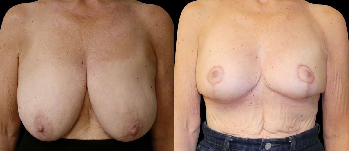 Breast Lift Before & After Gallery - Patient 807123 - Image 1