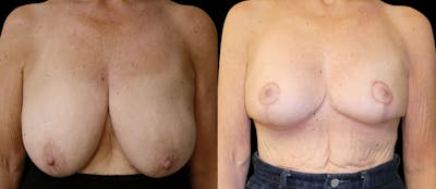 Breast Reduction + Lift Before & After Gallery - Patient 162854 - Image 1