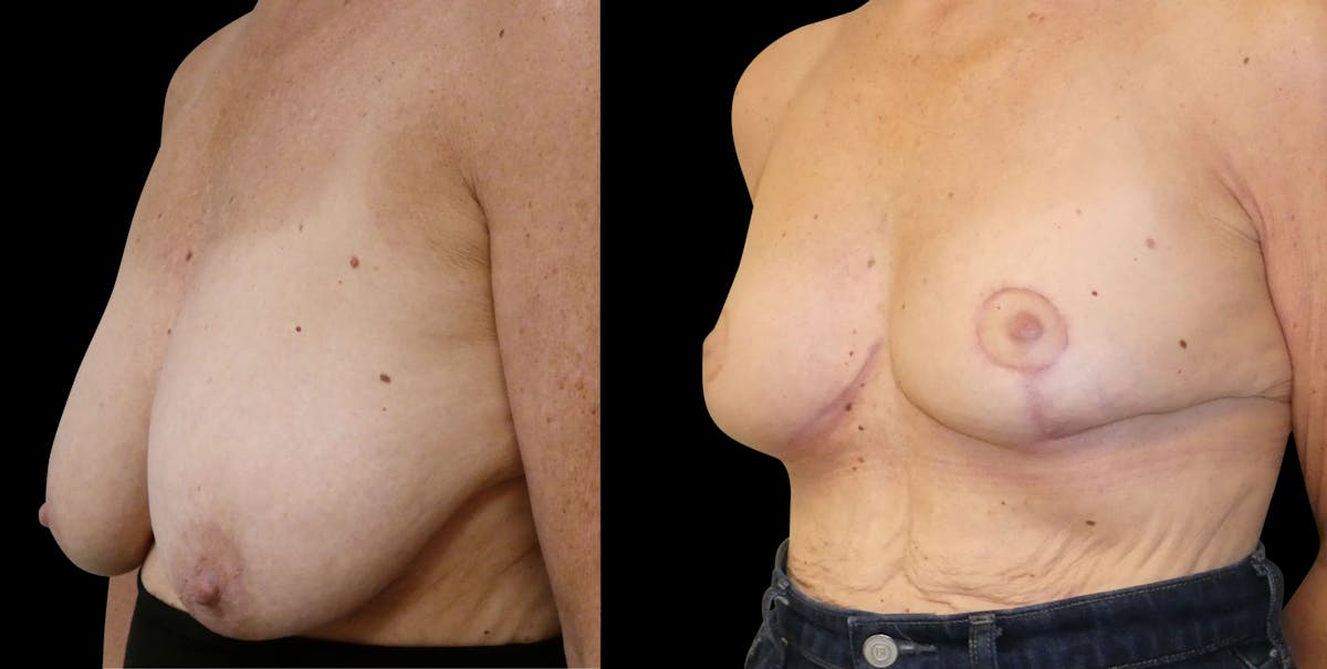 Breast Lift Before & After Gallery - Patient 807123 - Image 3