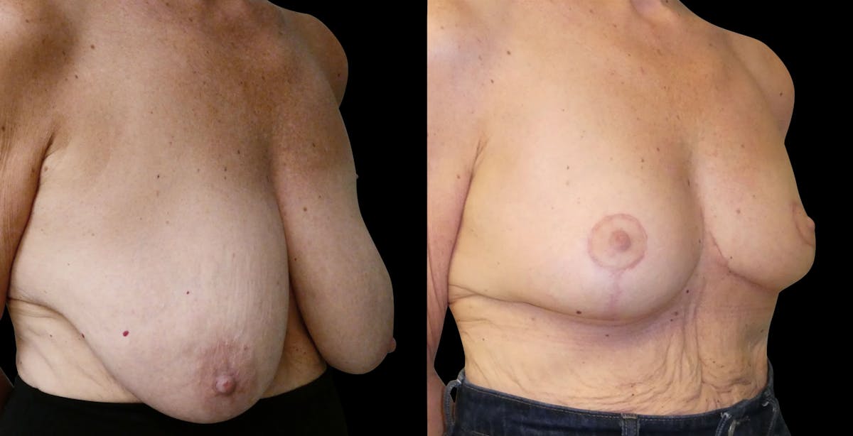 Breast Lift Before & After Gallery - Patient 807123 - Image 2