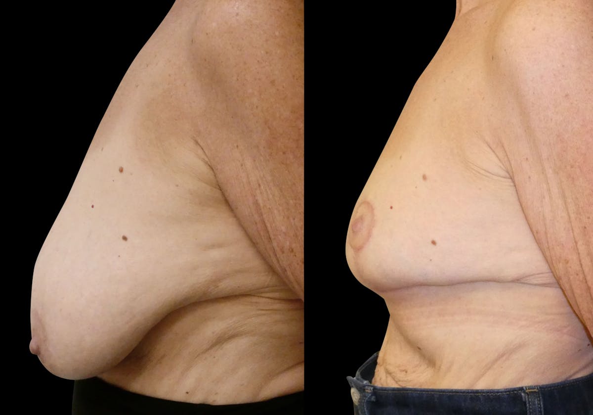 Breast Lift Before & After Gallery - Patient 807123 - Image 4