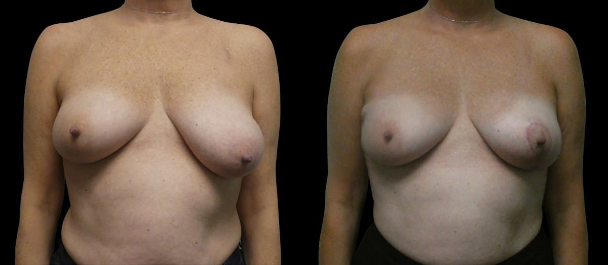 Symmetry Correction Before & After Gallery - Patient 292985 - Image 1