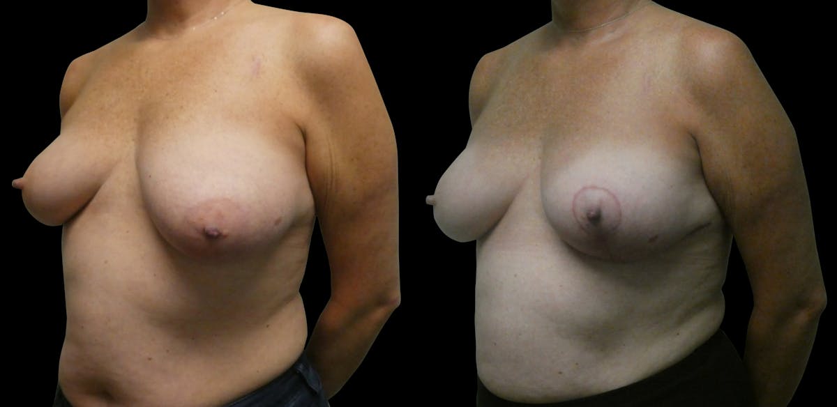 Symmetry Correction Before & After Gallery - Patient 292985 - Image 2