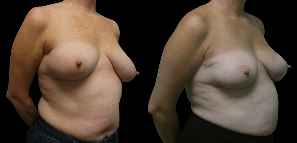 Symmetry Correction Before & After Gallery - Patient 292985 - Image 3