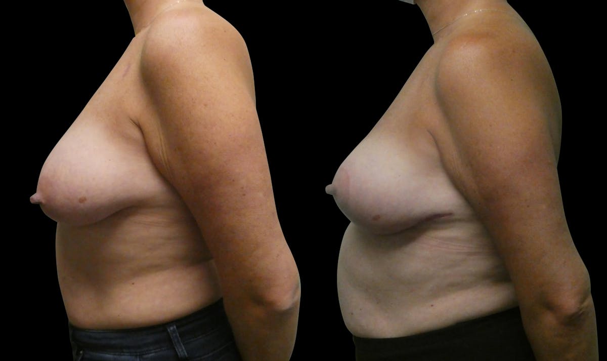 Symmetry Correction Before & After Gallery - Patient 292985 - Image 5