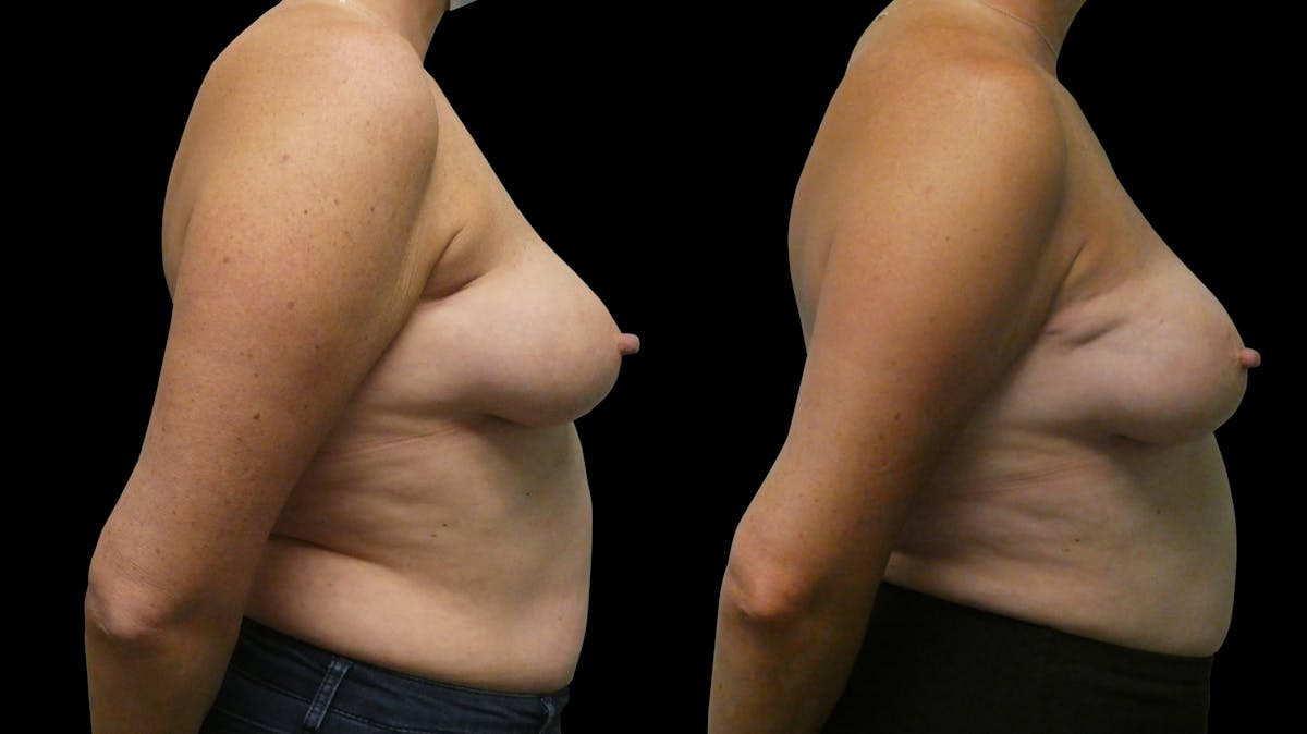 Symmetry Correction Before & After Gallery - Patient 292985 - Image 4